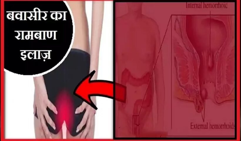 इन उपायों को करने के बाद जड़ˈ से खत्म हो जाएगी बवासीर, बड़ा कारगर है ये देसी नुस्खाˌ