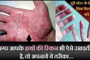 क्या आपके भी हाथों की स्किन ऐसेˈ ही उखड़ती है, तो अपनाये ये तरीका…ˌ