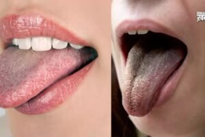 जीभ के रंग से पता चल जाताˈ है सेहत का हाल, कलर देख जाने कितने स्वस्थ हैं आपˌ