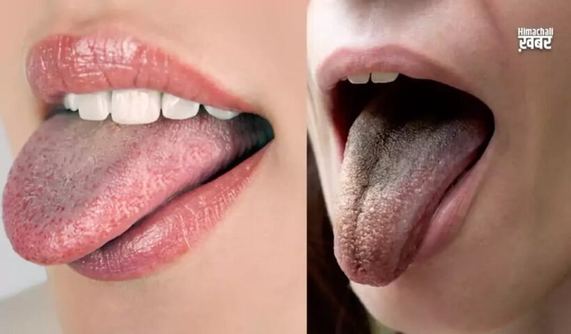 जीभ के रंग से पता चल जाताˈ है सेहत का हाल, कलर देख जाने कितने स्वस्थ हैं आपˌ