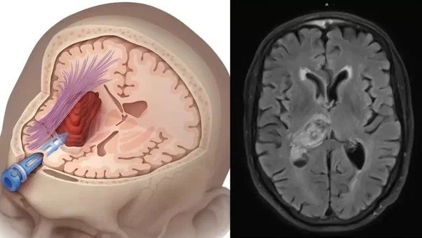 दिमाग की नस फटने से 1 दिनˈ पहले शरीर देता है ये संकेत, इग्नोर करने पर आता है अटैकˌ
