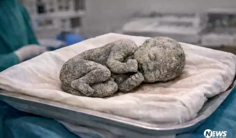 15सालों से मां की कोख​ में पल रहा था बच्चा, ऑपरेशन के बाद निकला पत्थर का बच्चा
