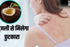 Summer Skin Care Remedy: गर्मी से हो रही खुजली-महीन दानों का होगा सफाया, नारियल तेल में मिलाकर लगा लें ये 1 चीज