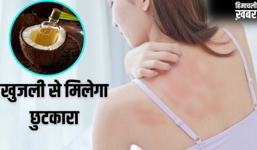 Summer Skin Care Remedy: गर्मी से हो रही खुजली-महीन दानों का होगा सफाया, नारियल तेल में मिलाकर लगा लें ये 1 चीज