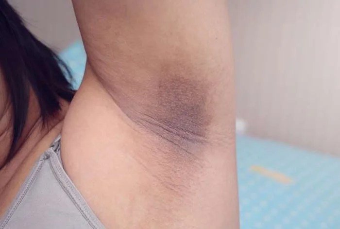 अंडरआर्म्स और जांघों के कालेपन से मिल जाएगी निजात, बस करना होगा ये काम
