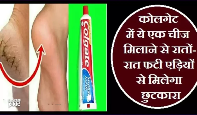 कोलगेटमें ये एक चीज मिलाने​ से रातों-रात फटी एड़ियों से मिलेगा छुटकारा