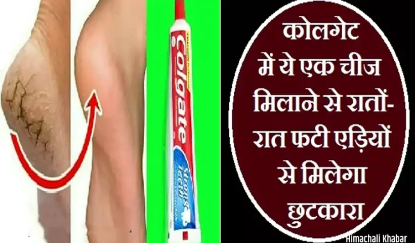 कोलगेटमें ये एक चीज मिलाने​ से रातों-रात फटी एड़ियों से मिलेगा छुटकारा