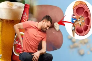 क्याबियर पीने से पथरी बाहर​ निकल जाती है? जाने विशेषज्ञ इस बारे में क्या कहते हैं