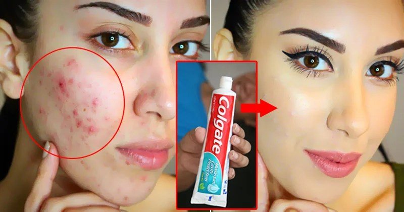 टूथपेस्टˈ से रातों-रात गायब करें पिंपल, यहां जाने लगाने का तरीका