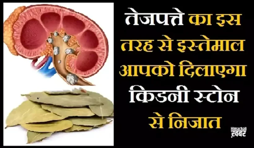 तेजपत्तेका इस तरह से इस्तेमाल​ आपको दिलाएगा किडनी स्टोन से निजात