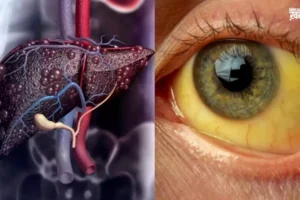 नकरें नजरअंदाज. लीवर को सड़ा​ देती है ये बीमारी आंखों में पीलापन समेत दिखते हैं ये लक्षण