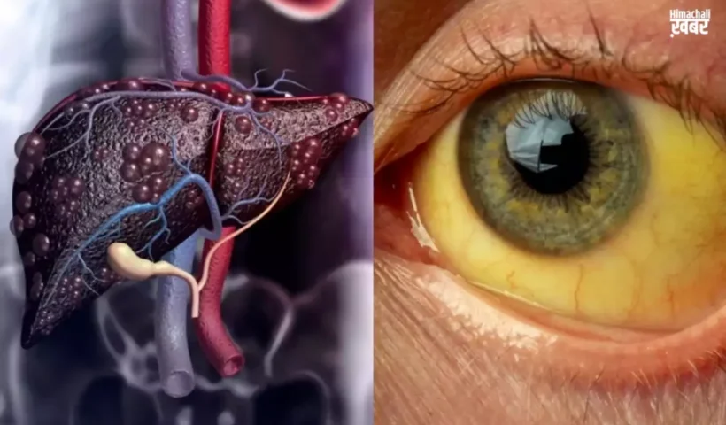 नकरें नजरअंदाज. लीवर को सड़ा​ देती है ये बीमारी आंखों में पीलापन समेत दिखते हैं ये लक्षण