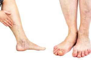 पैरकी नस चढ़ने से हैं​ परेशान? अपनाएं ये 6 उपाय तुरंत ठीक हो जाएगा नसों का दर्द व खिंचाव