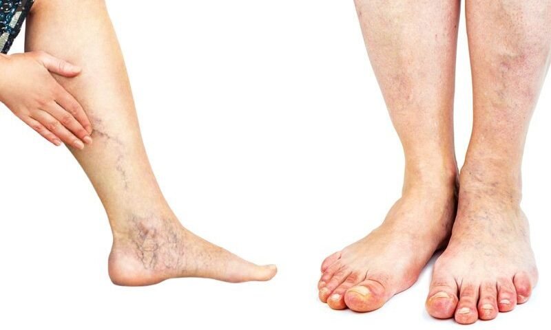 पैरकी नस चढ़ने से हैं​ परेशान? अपनाएं ये 6 उपाय तुरंत ठीक हो जाएगा नसों का दर्द व खिंचाव