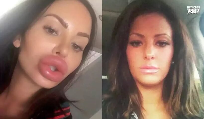 प्लास्टिक की गुड़िया बनने के लिए महिला ने उड़ाए 97 लाख रूपए, अब सर्जरी के बाद हो गया ऐसा हाल