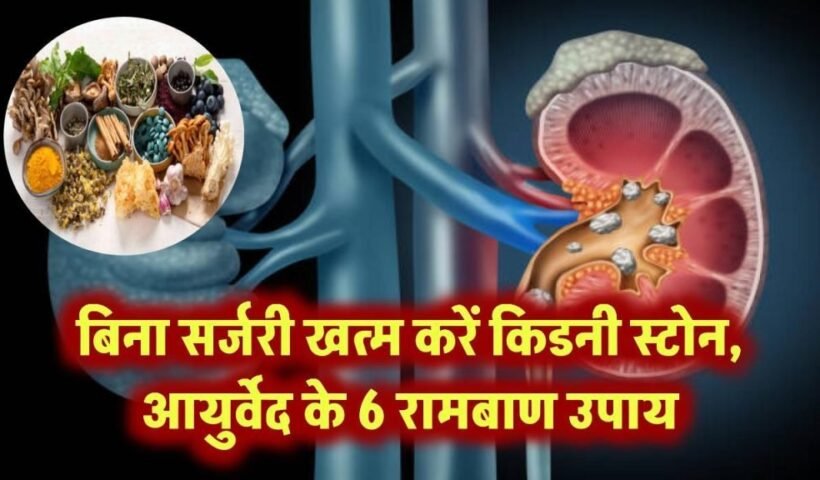 बिनासर्जरी घुल जाएंगे किडनी स्टोन!​ जानिए आयुर्वेद डॉक्टर के 6 रामबाण उपाय