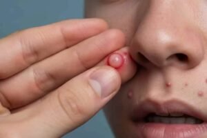 भूलकर भी चेहरे की इस जगह पर पिंपल न फोड़ें, सीधा दिमाग पर होता है असर