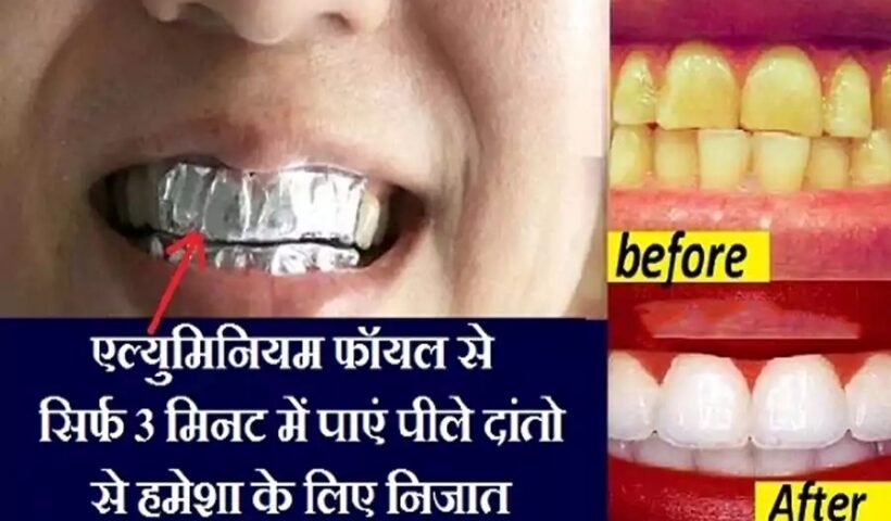 सिर्फ 3 मिनट में एल्युमिनियम फॉयल से पाएं पीले दांतो से हमेशा के लिए निजात