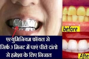सिर्फˈ 3 मिनट में एल्युमिनियम फॉयल से पाएं पीले दांतो से हमेशा के लिए निजात