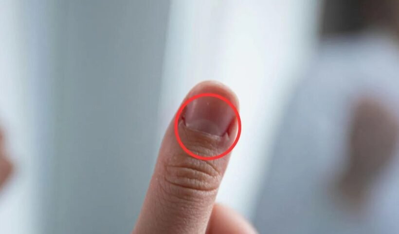 हमारे नाखूनों पर क्यों बनते हैं सफेद निशान? अगर आपके भी है तो आज जान लीजिए कारण