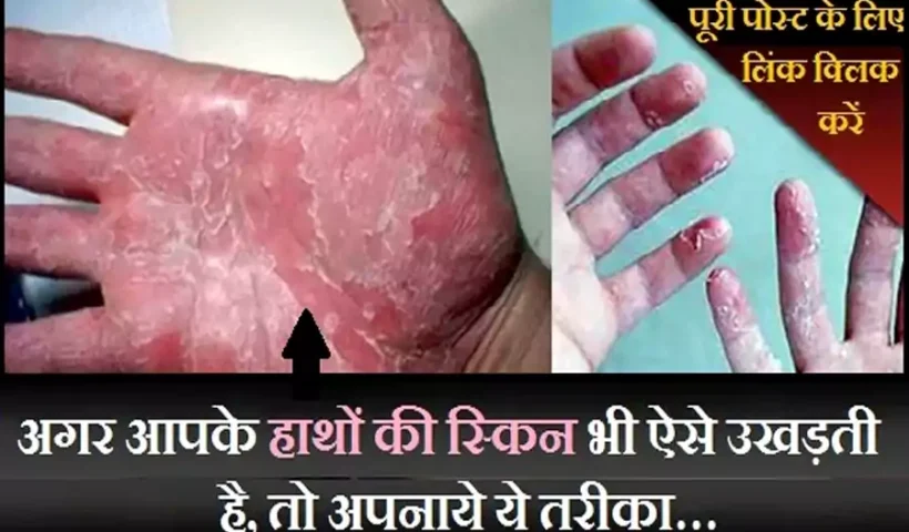 ​​क्या आपके भी हाथों की स्किन ऐसे ही उखड़ती है, तो अपनाये ये तरीका…​​​​​