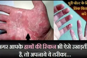 ​​क्या आपके भी हाथों की स्किन ऐसे ही उखड़ती है, तो अपनाये ये तरीका…​​​​​