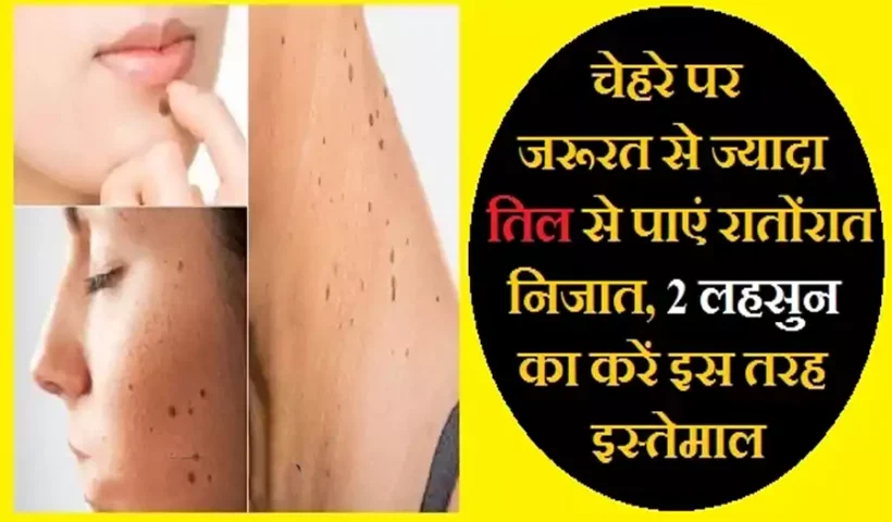 ​​चेहरे पर जरूरत से ज्यादा तिल से पाएं रातों रात निजात, 2 लहसुन का करें इस तरह इस्तेमाल​​​​​