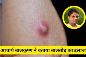 ​​बालतोड़ का इलाज जल्दी कैसे करें? Acharya Balkrishna ने बताया कैसे ठीक होंगे ये फोड़े​​​​​