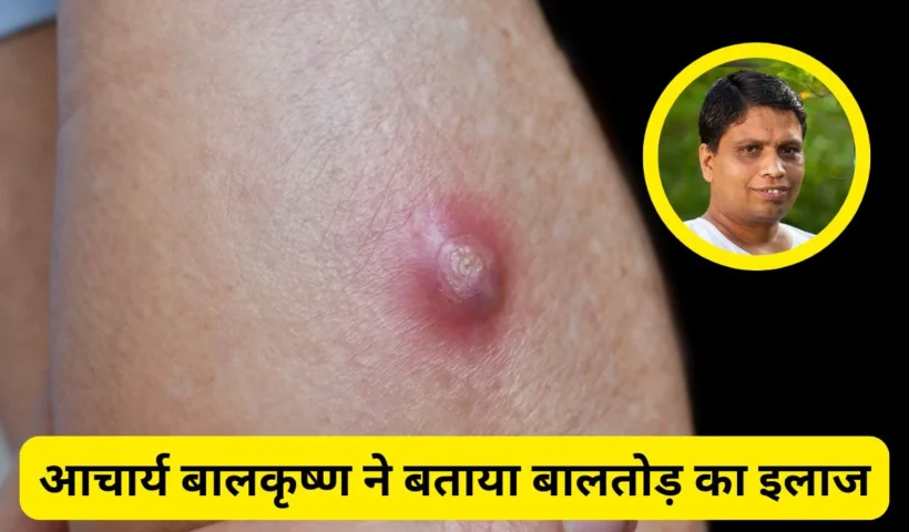 ​​बालतोड़ का इलाज जल्दी कैसे करें? Acharya Balkrishna ने बताया कैसे ठीक होंगे ये फोड़े​​​​​